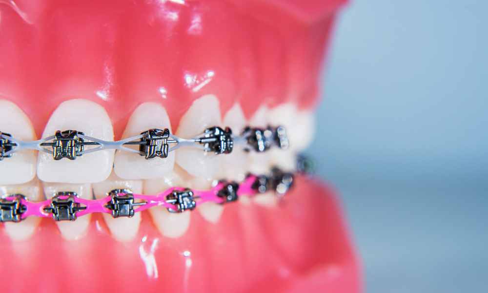 Transform Your Smile with Carle Place Braces: A Comprehensive Guide
